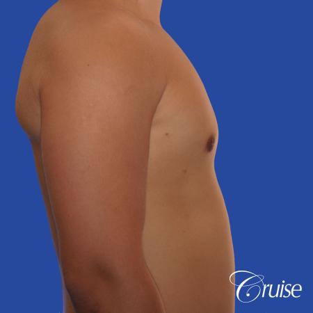 mild gynecomastia with puffy nipple and areola incision - After Image 3