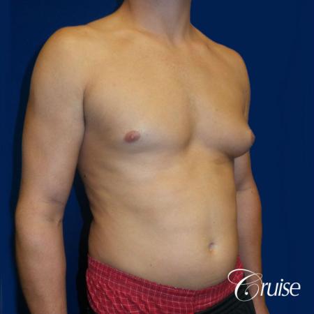 Unilateral gynecomastia - Before Image 2
