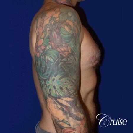 Moderate Gynecomastia -Areola Incision - After Image 3