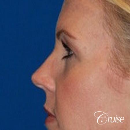 best upper eye lid results - Before Image 3