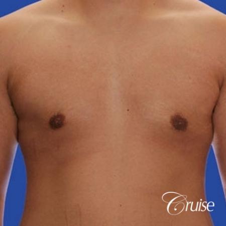 mild gyne on 24yr old adult - After Image 1