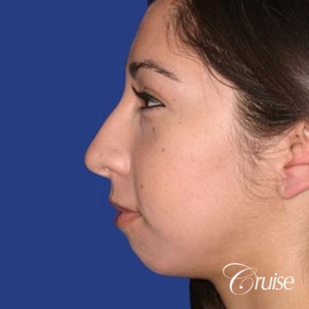 anatomic chin implant with top plastic surgeon in Newport Beach - Before and After Image 2