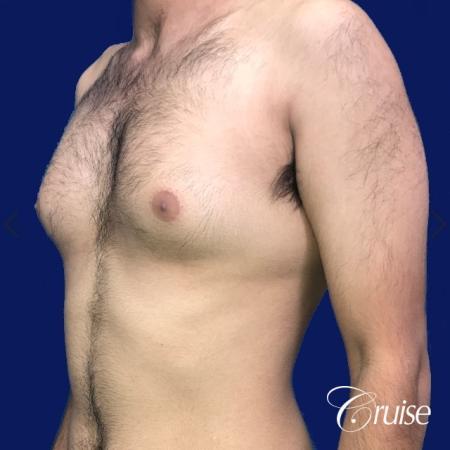 Moderate Gynecomastia Areola Incision - Before and After Image 3