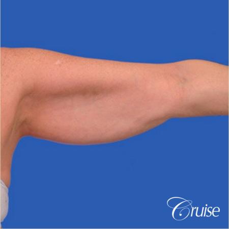 best arm lift newport beach - Before Image 1