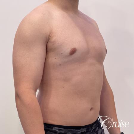 Gynecomastia: Patient 123 - After 4
