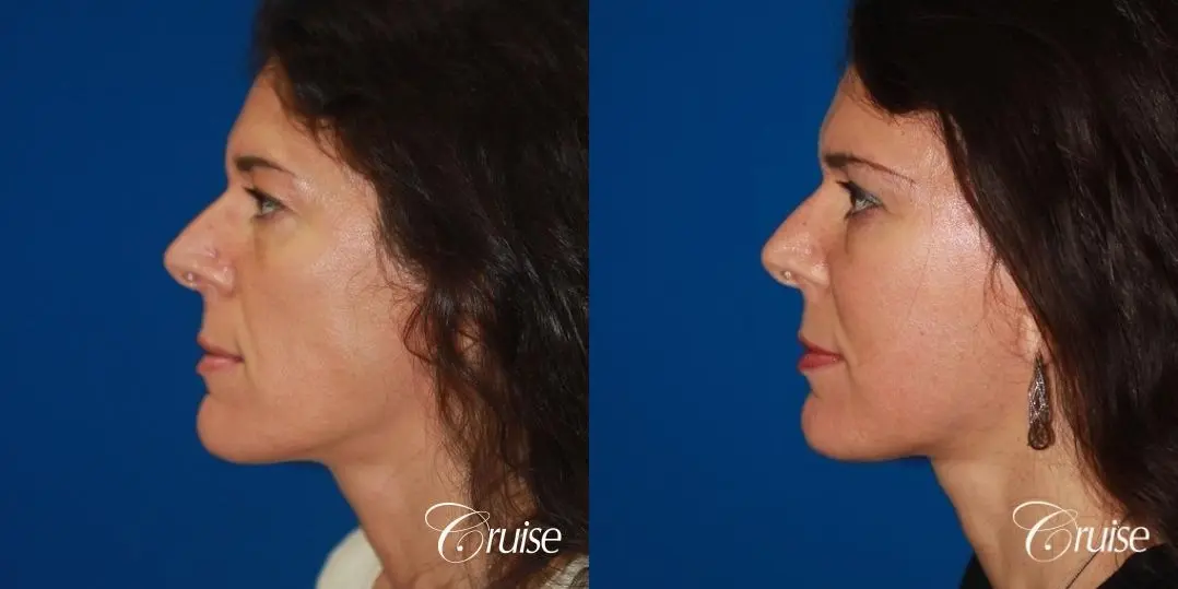 Facelift in Newport Beach, CA - Before and After 2