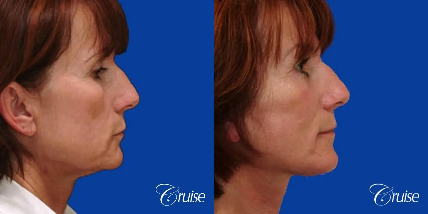 lower facelift newport beach ca - Before and After 3