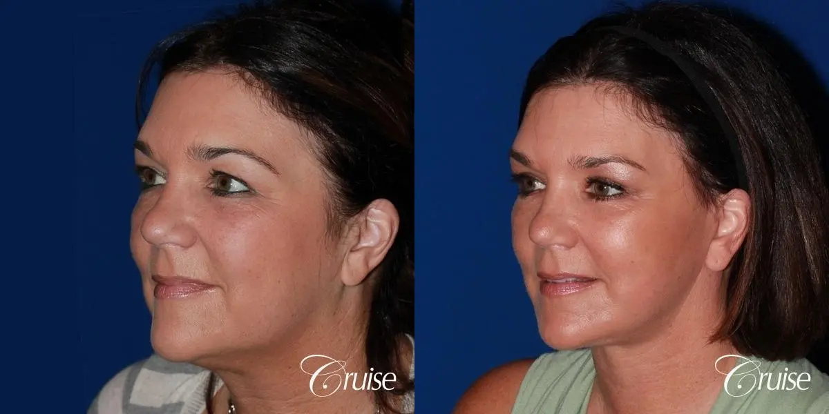 midface with lower face and neck lift orange county - Before and After 3