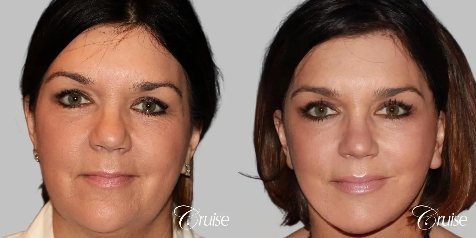 midface with lower face and neck lift orange county - Before and After