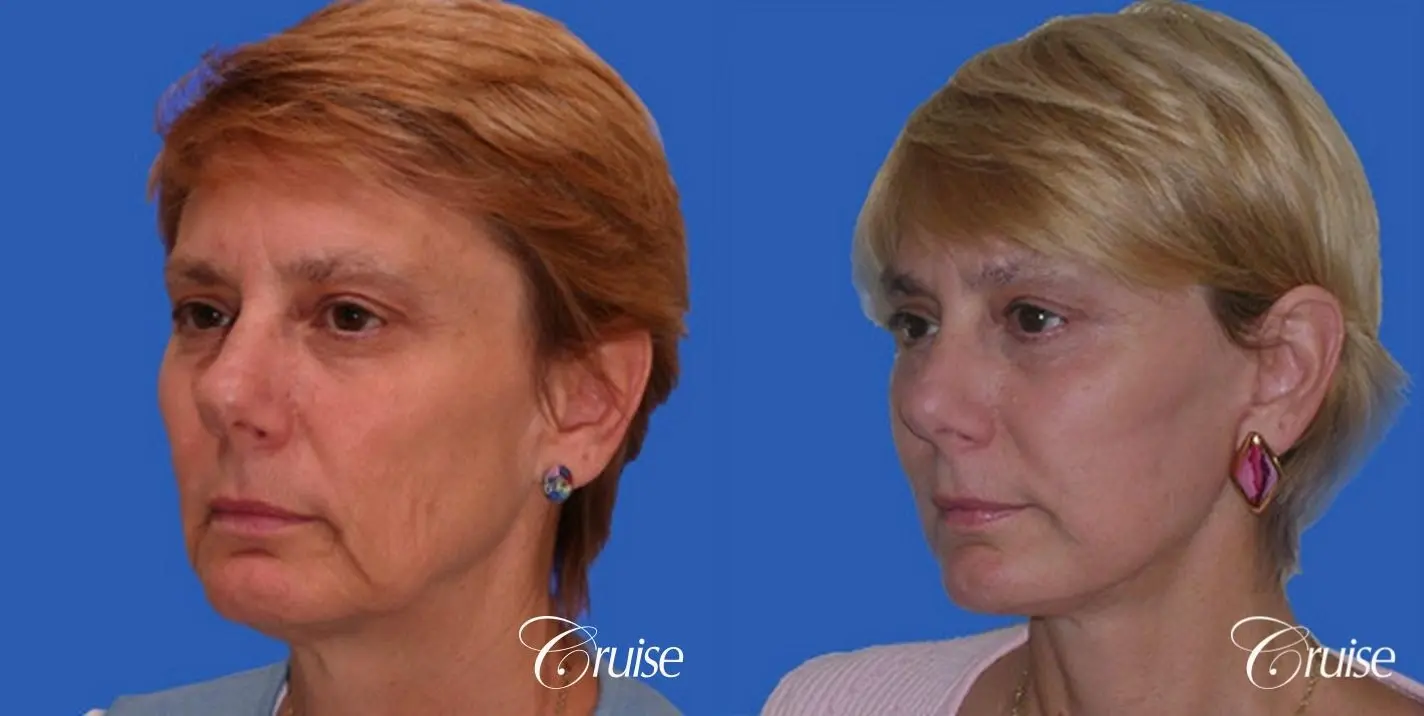 Facelift - Before and After 2