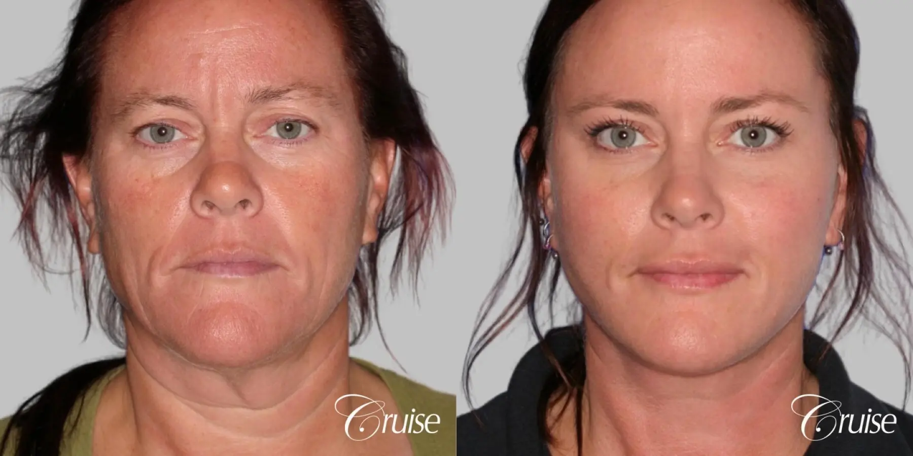 Face Lift, Neck Lift, Upper Blepharoplasty, Temple Lift - Before and After 1