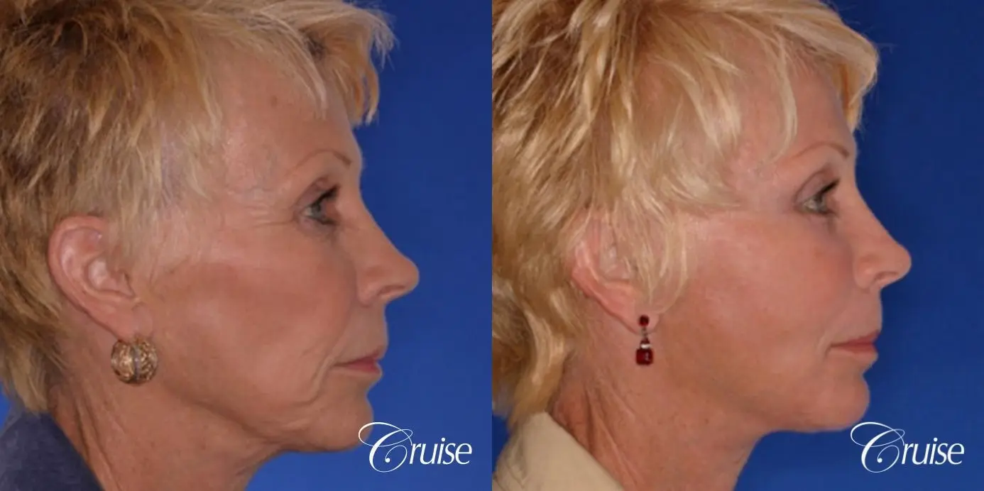 Facelift - Before and After 3