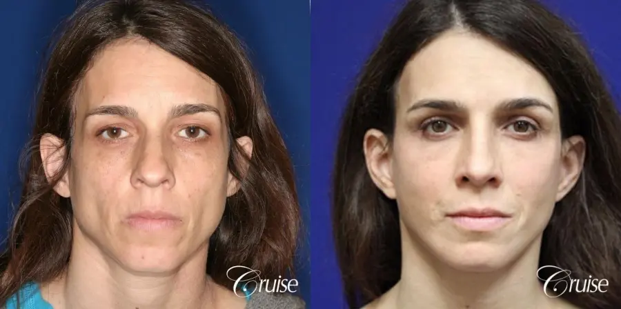 complete facial rejuvenation orange county - Before and After