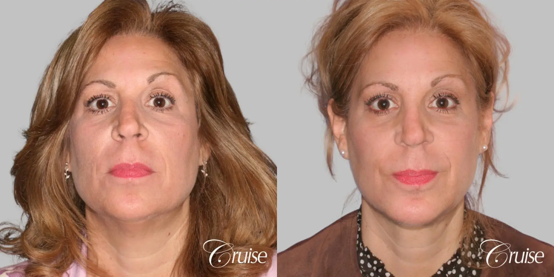 Lower Facelift, Neck Lift, Medium Chin Implant - Before and After 1