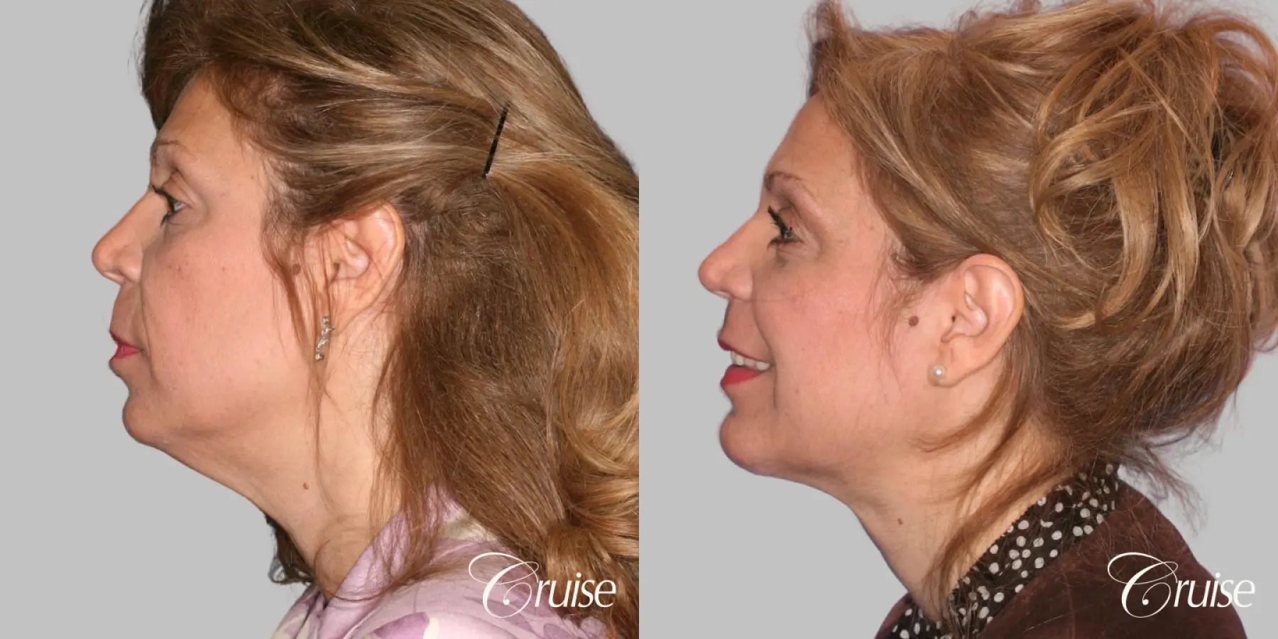 Lower Facelift, Neck Lift, Medium Chin Implant - Before and After 2