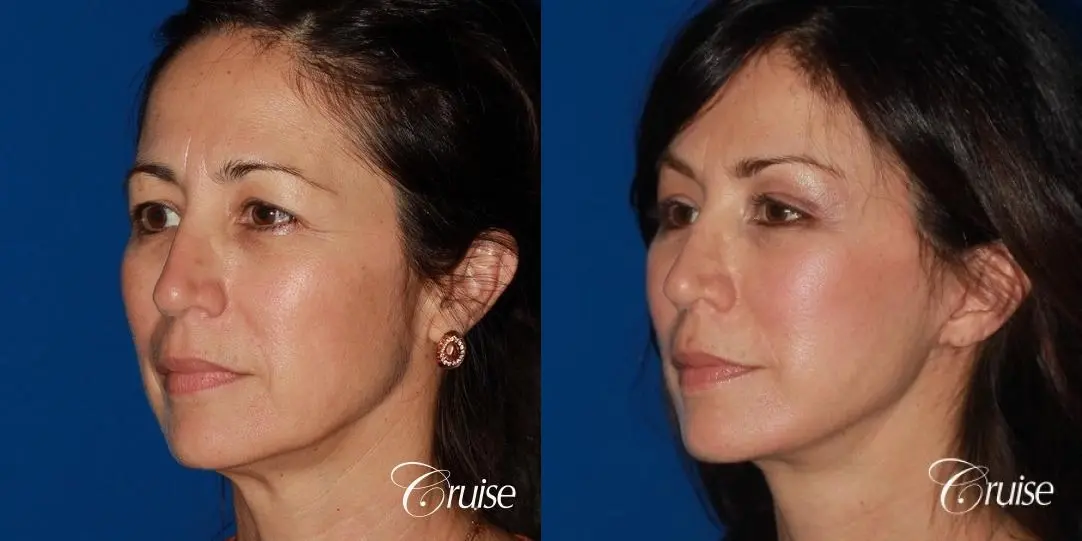 Facelift - Before and After 2