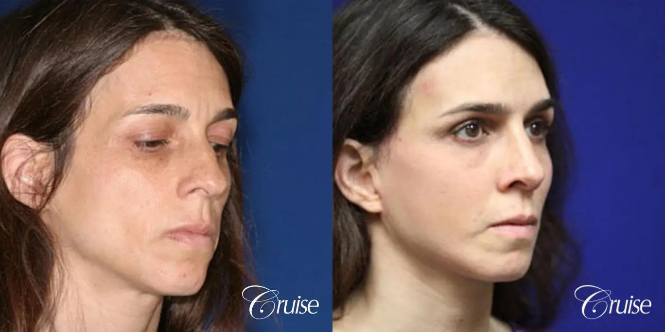 complete facial rejuvenation orange county - Before and After 4