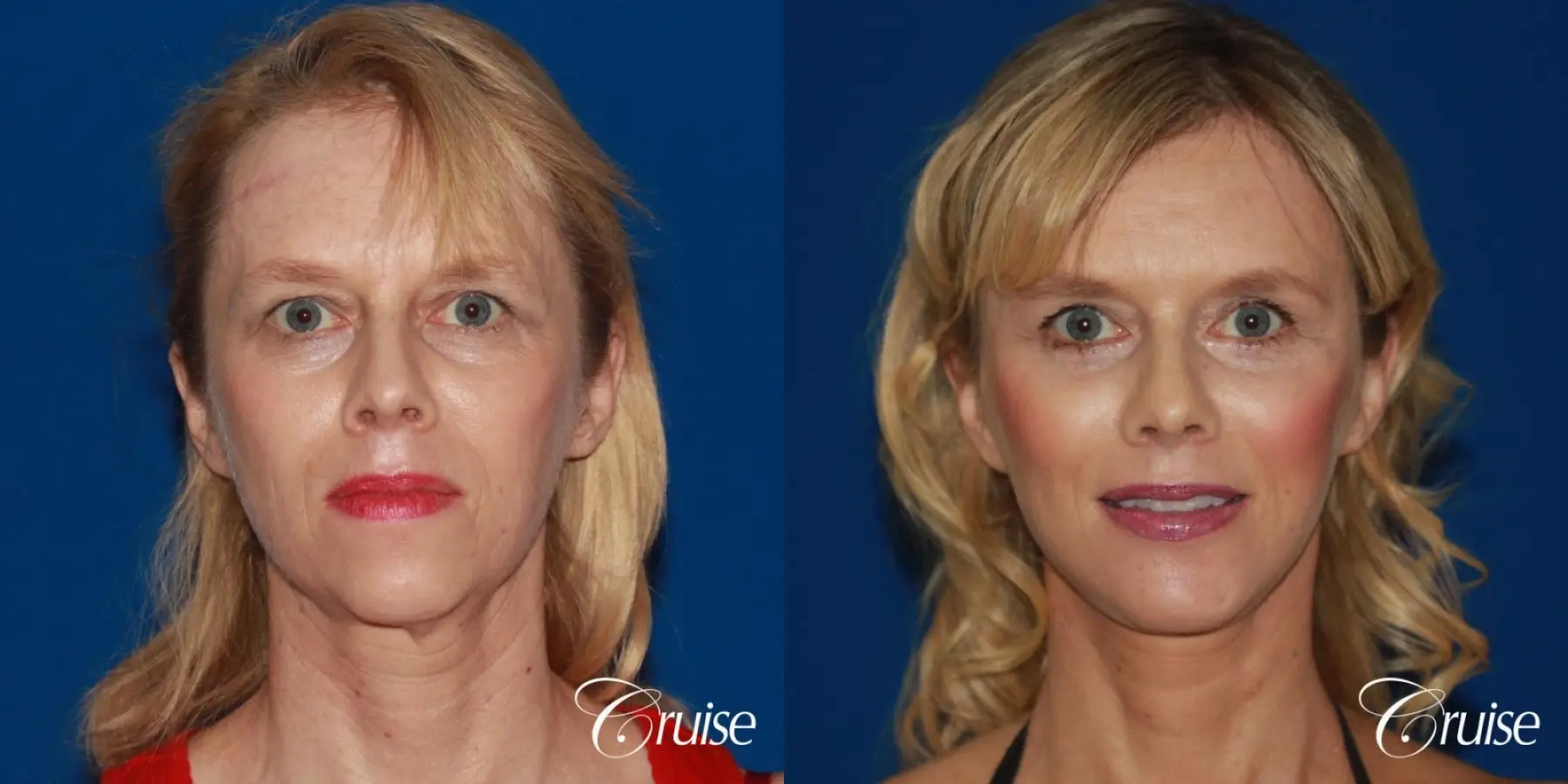 facial rejuvenation newport beach ca - Before and After 4