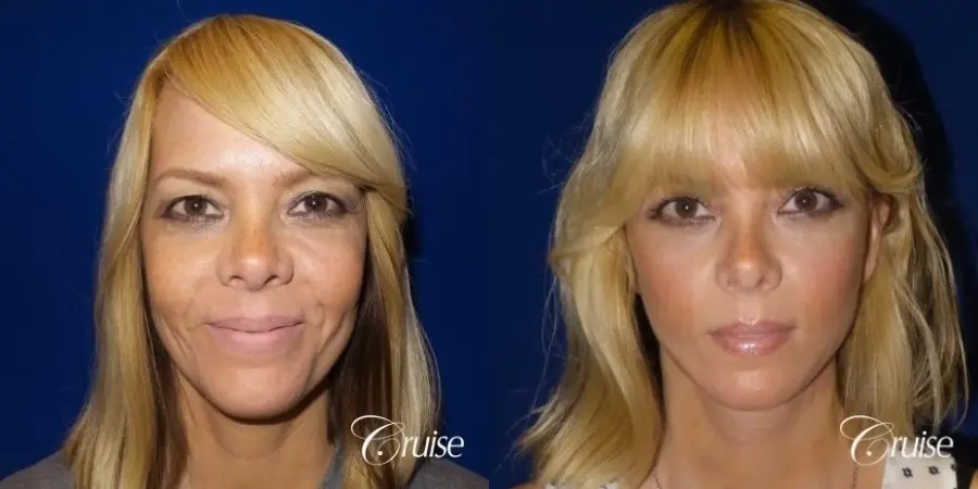 Lower Facelift 45 yrs old - Before and After  
