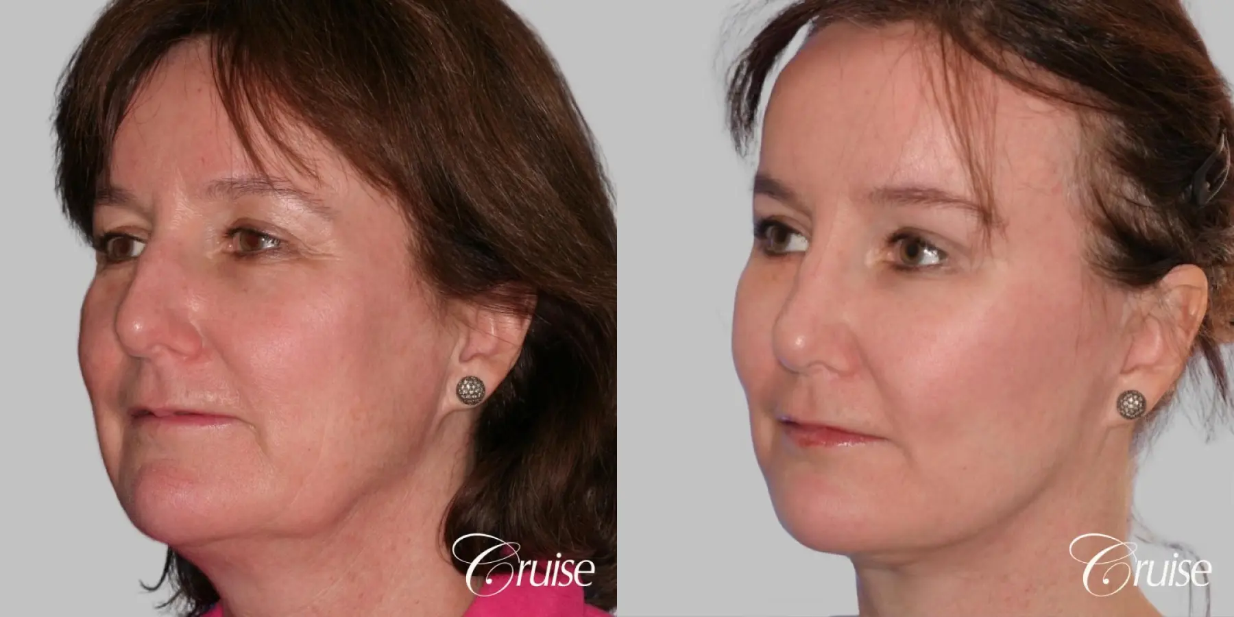 Facelift, Necklift, Fat Transfer - Before and After 3