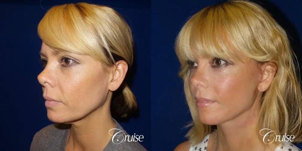 Lower Facelift 45 yrs old - Before and After 2