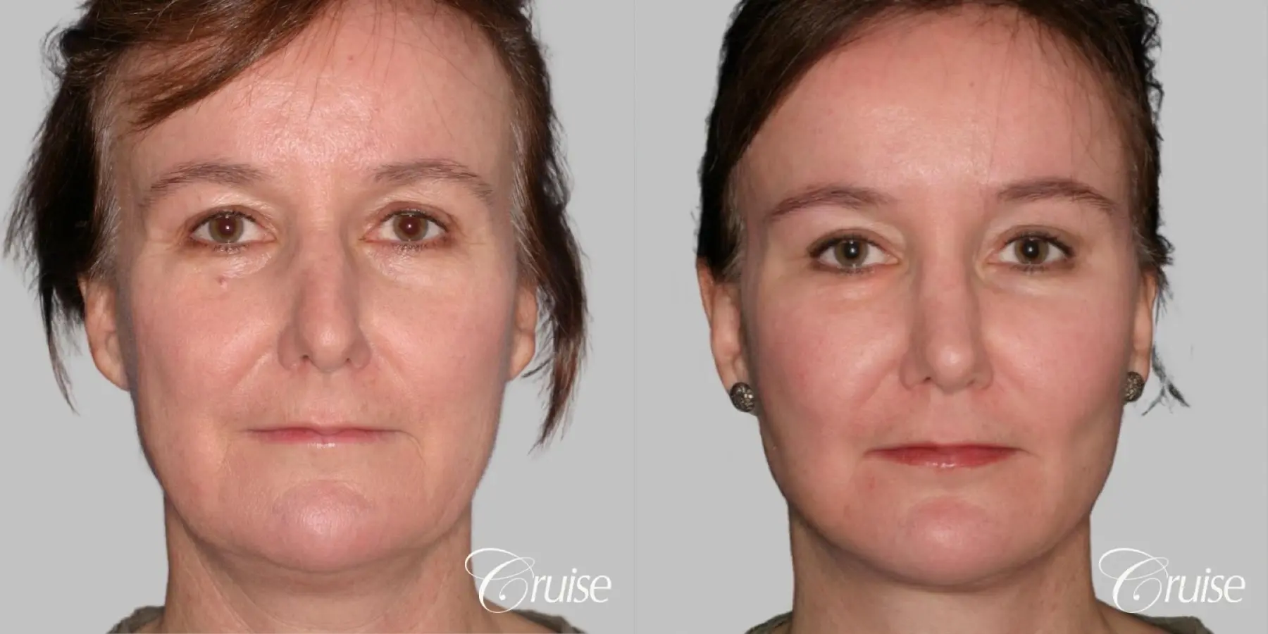 Facelift, Necklift, Fat Transfer - Before and After 1
