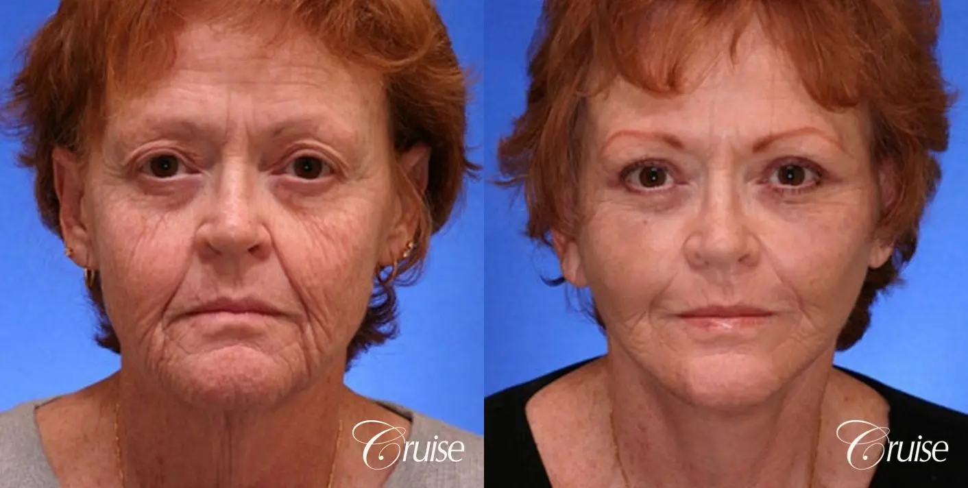 Facelift, Browlift, Temple Lift, Eyelid Surgery - Before and After 1