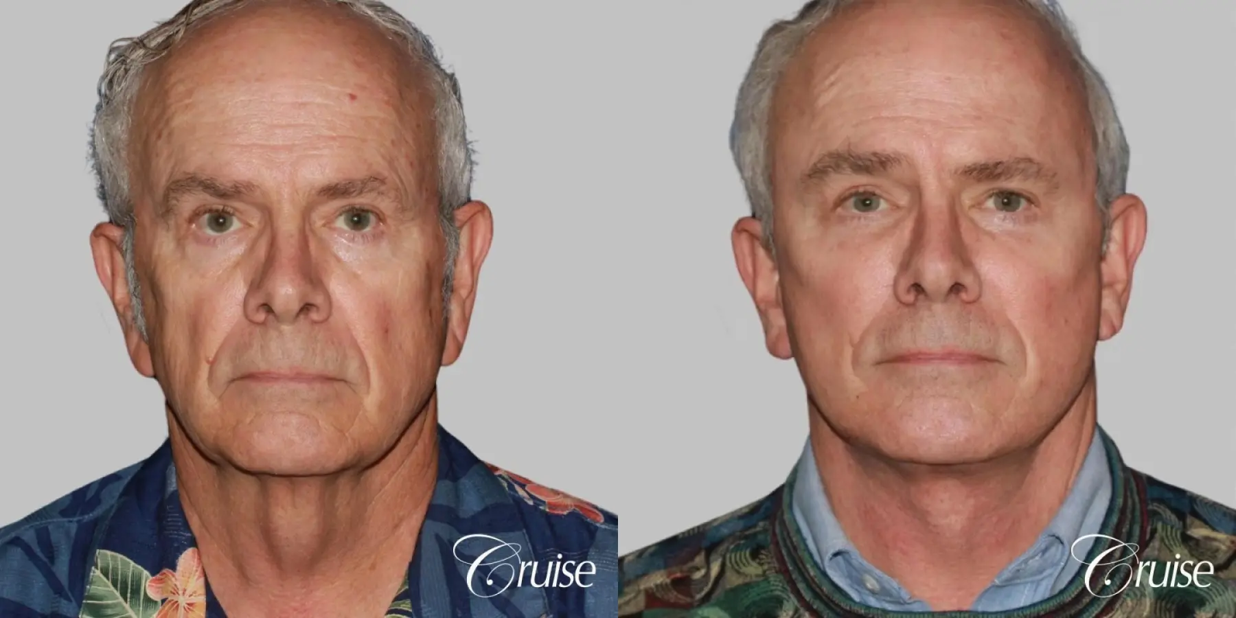 Facelift in Newport Beach, CA - Before and After