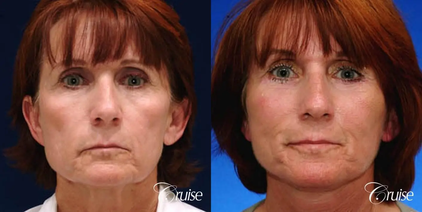 lower facelift newport beach ca - Before and After