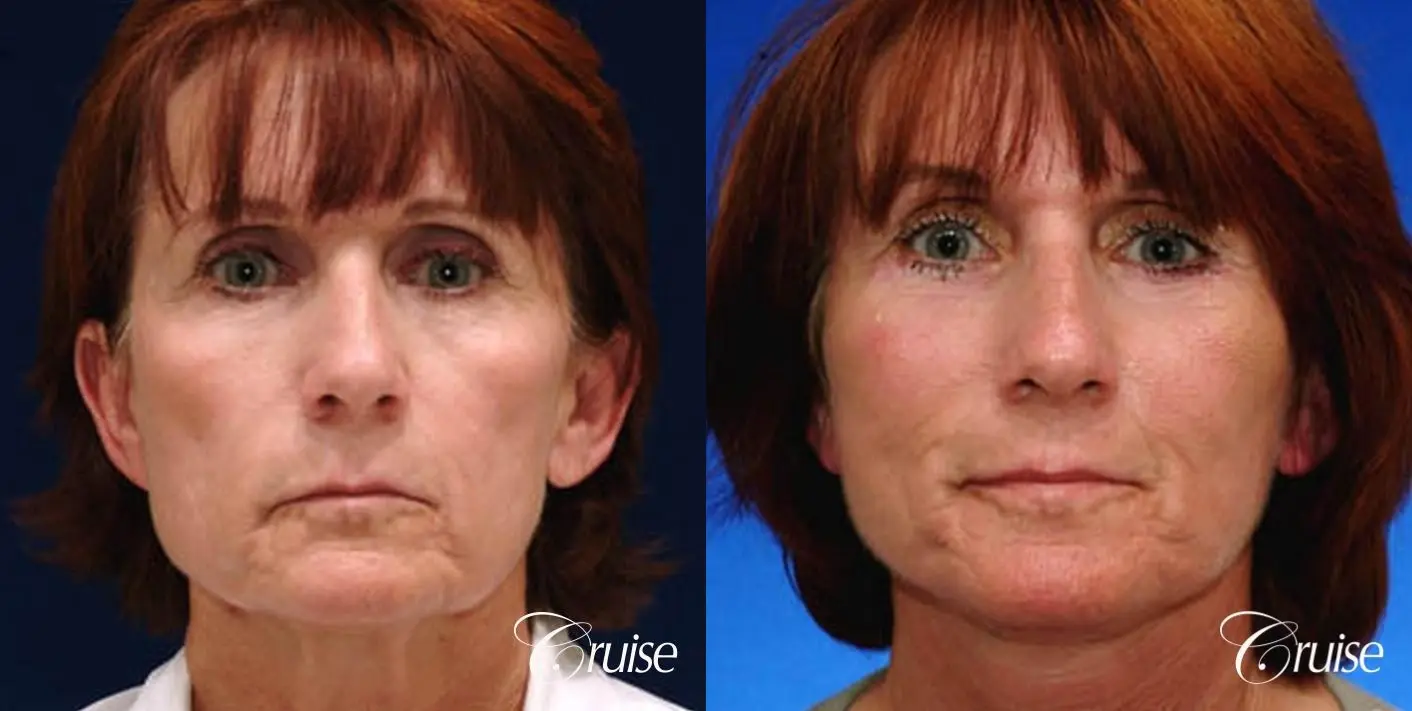 lower facelift newport beach ca - Before and After 1