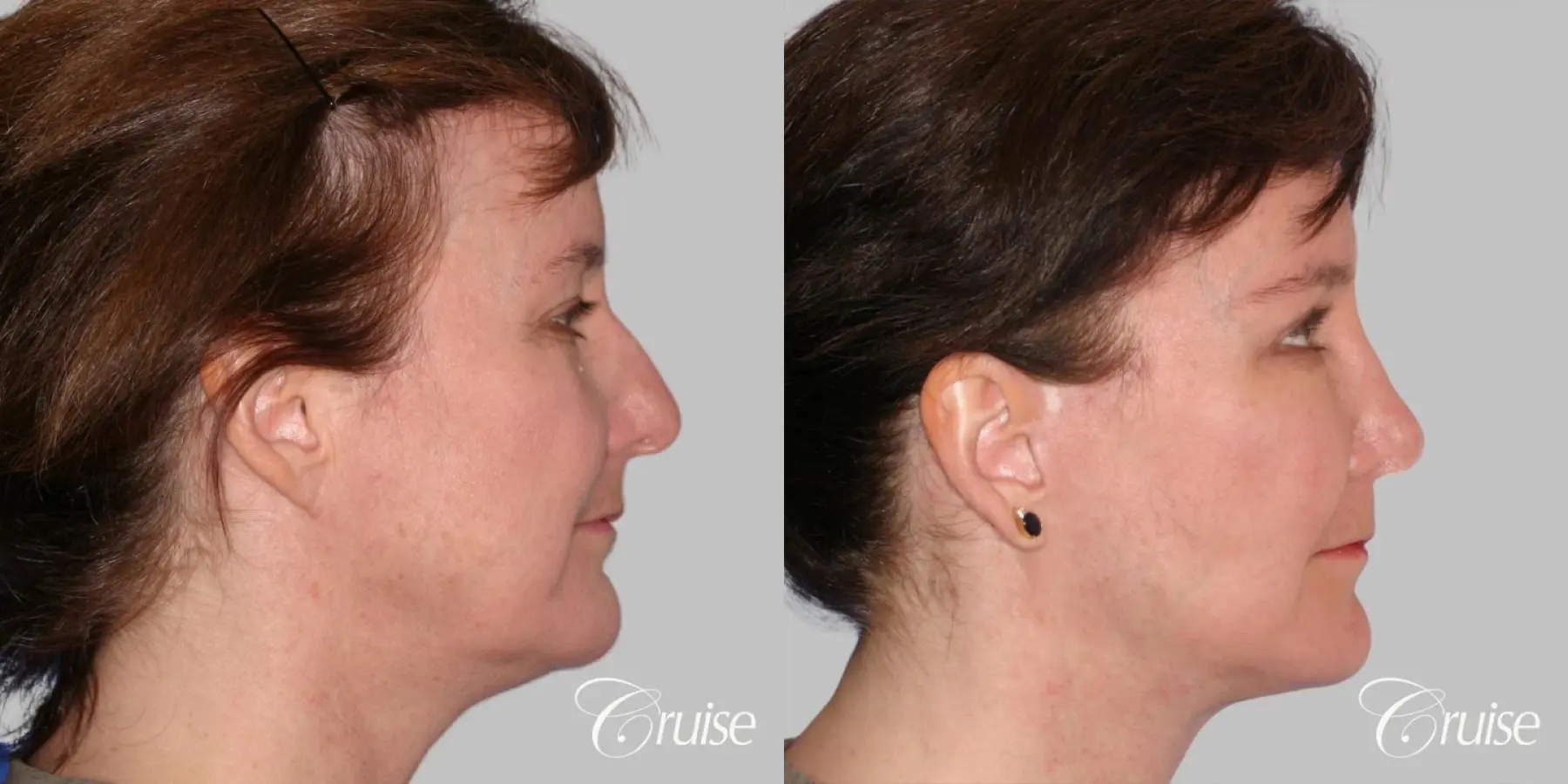 Facelift, Necklift, Fat Transfer - Before and After 2