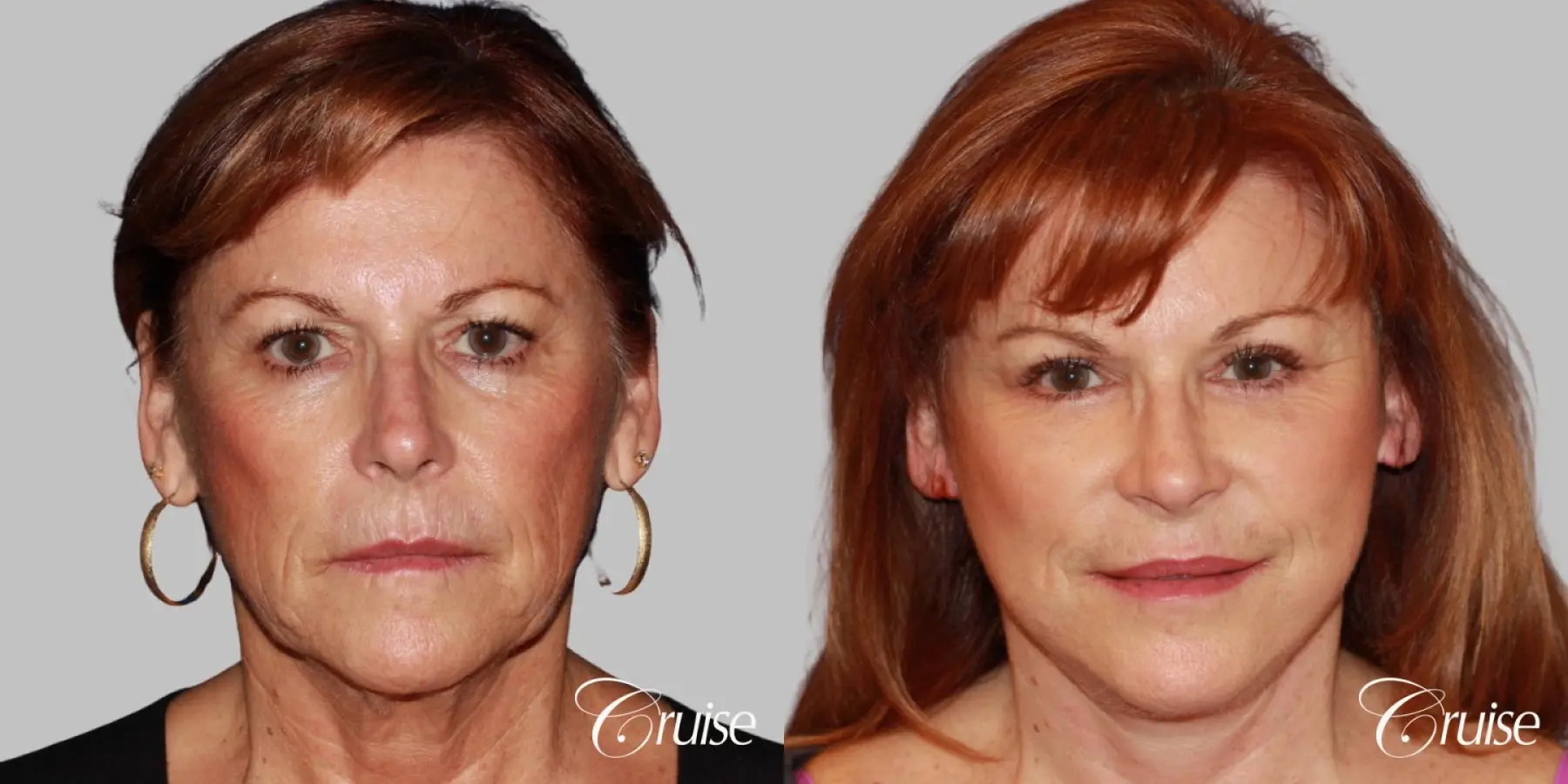 facial rejuvenation orange county ca - Before and After