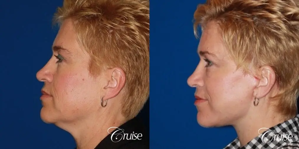 Facelift in Newport Beach, CA - Before and After 2