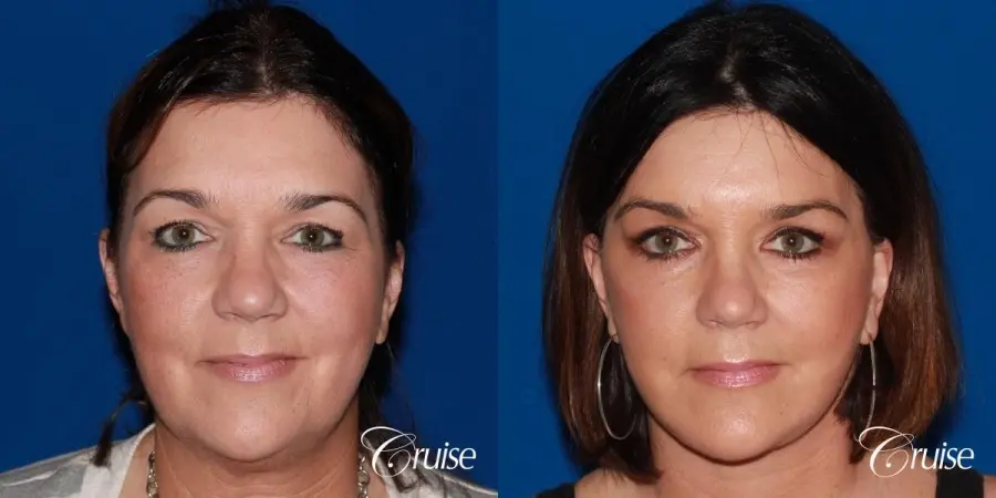 midface with lower face and neck lift orange county - Before and After