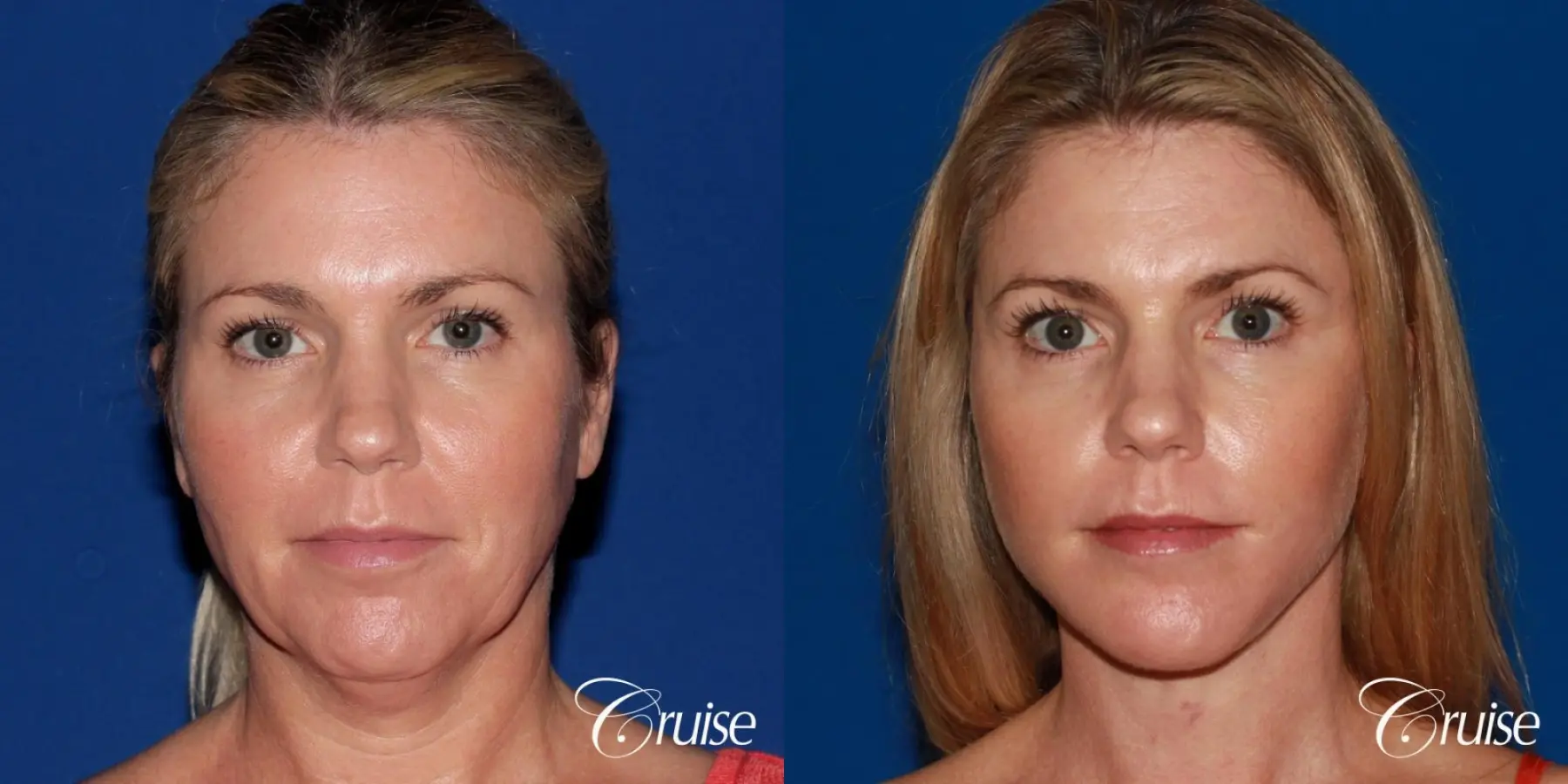lower facelift with chin liposuction - Before and After