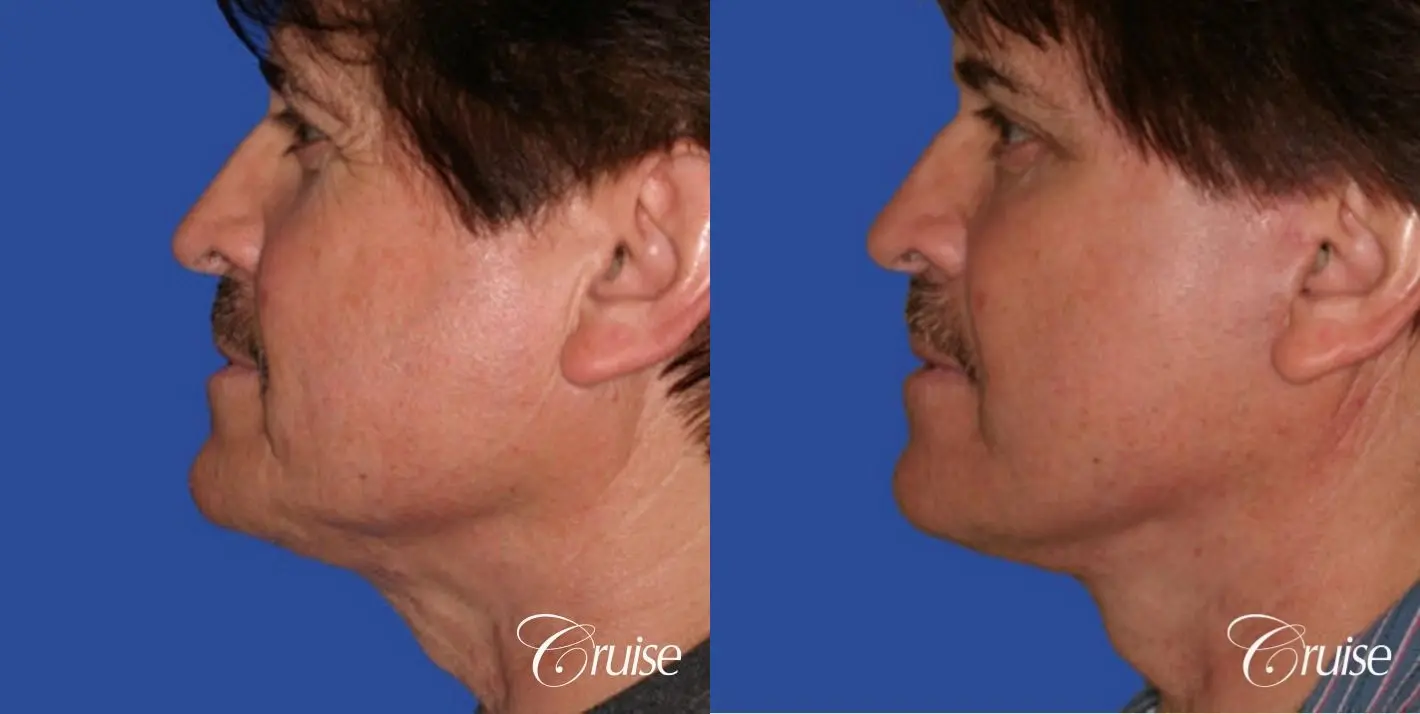 Facelift in Newport Beach, CA - Before and After 2