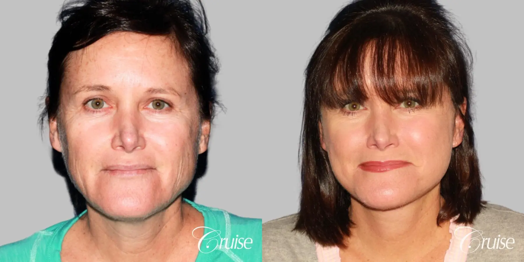 Mid-Facelift, Neck Tightening - Before and After 1