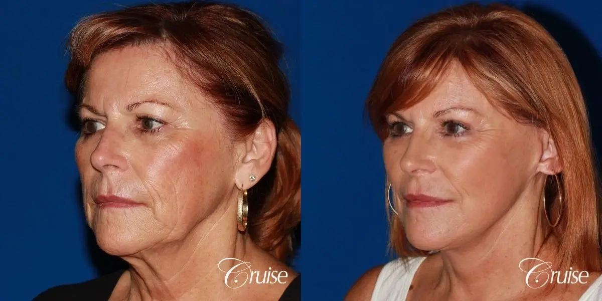 facial rejuvenation orange county ca - Before and After 3