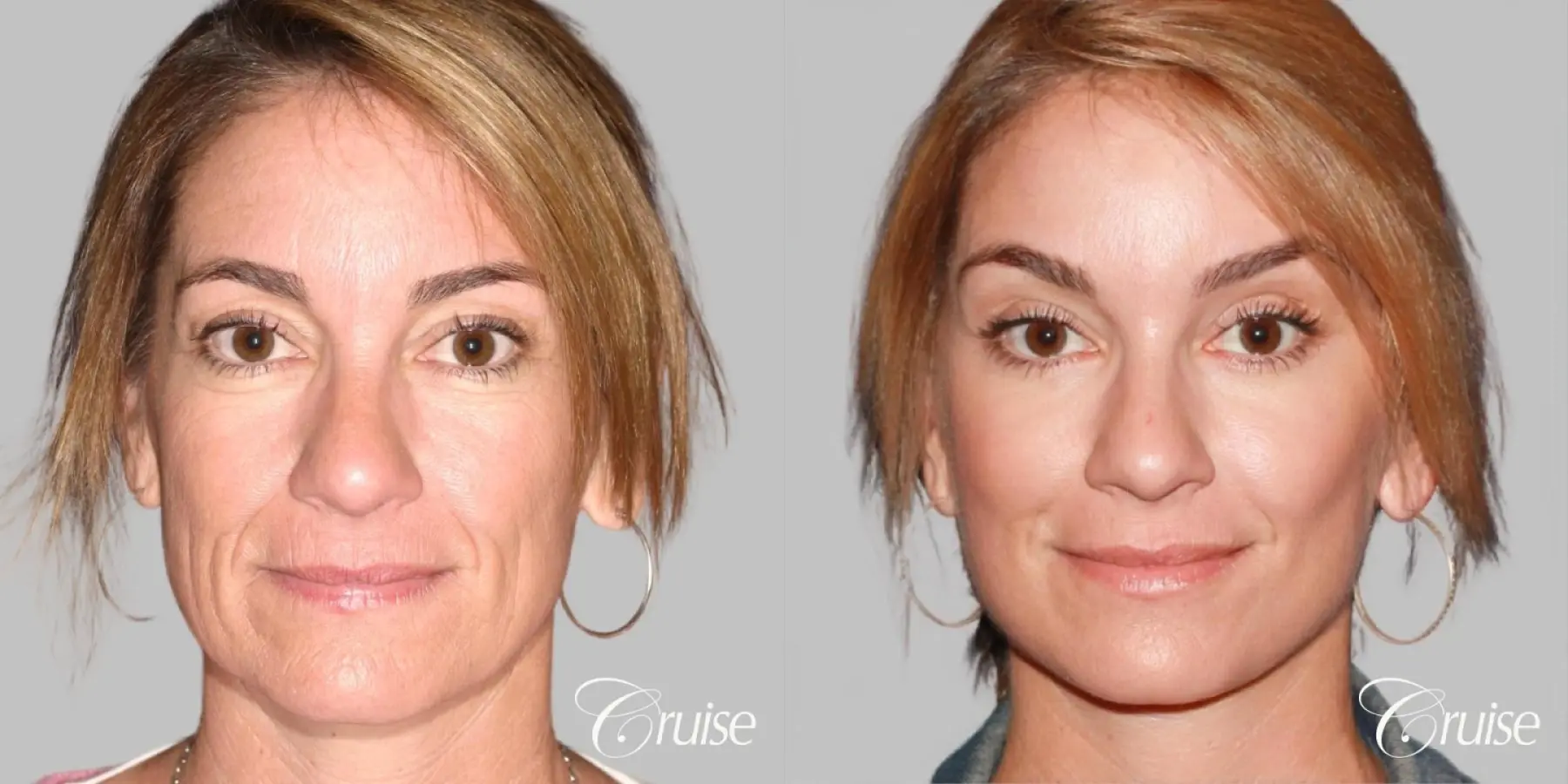 Female - Facelift, Neck Tightening, Fat Transfer - Before and After