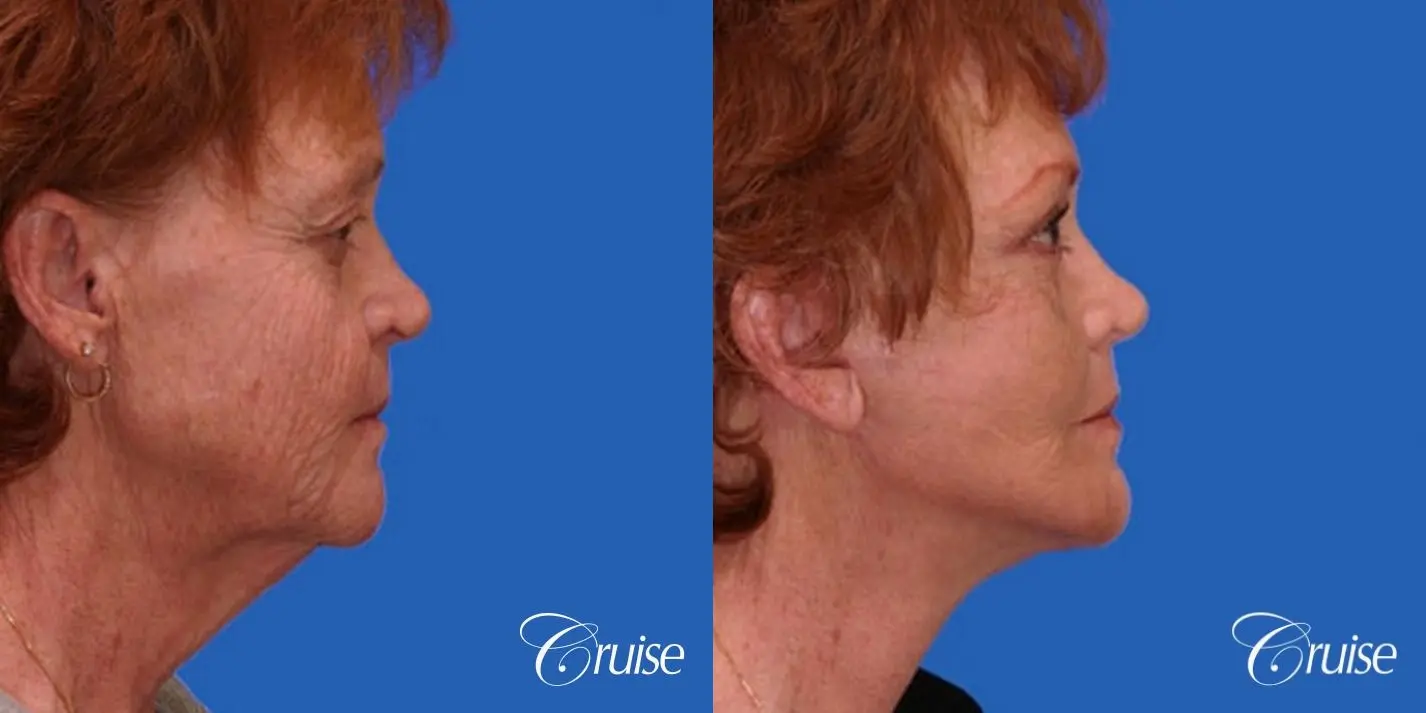 Facelift, Browlift, Temple Lift, Eyelid Surgery - Before and After 3
