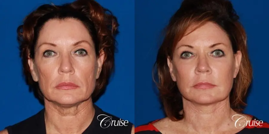 lower face and neck lift dr. joseph cruise - Before and After