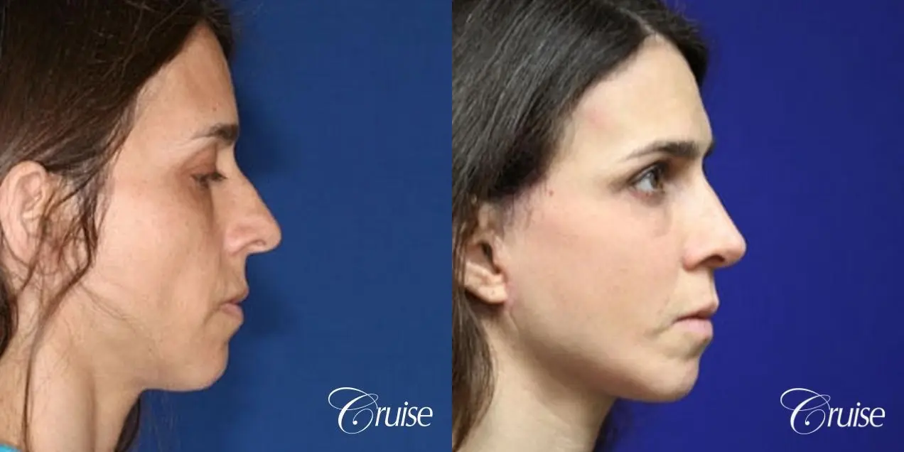 complete facial rejuvenation orange county - Before and After 5