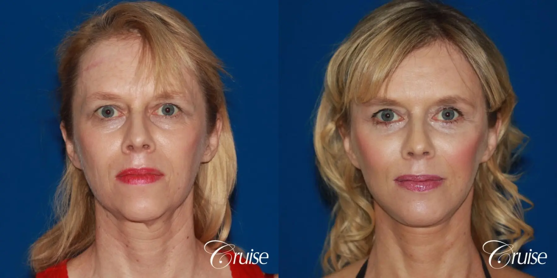 facial rejuvenation newport beach ca - Before and After