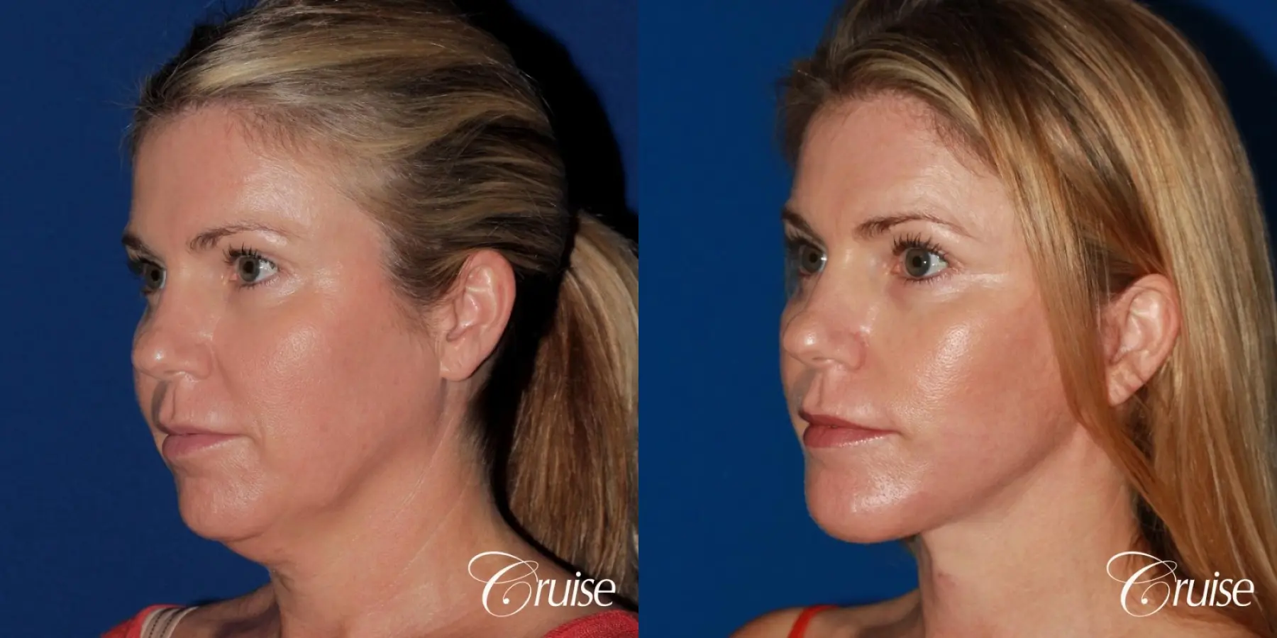 lower facelift with chin liposuction - Before and After 3