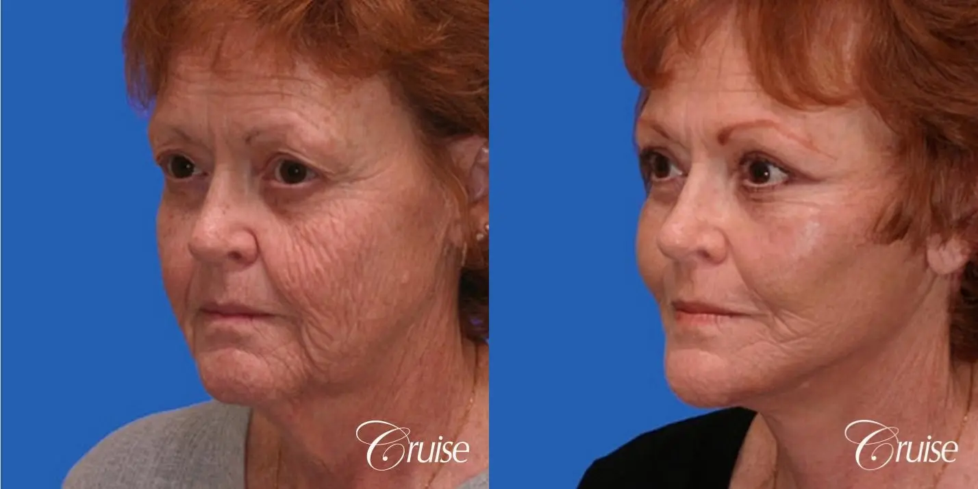 Facelift, Browlift, Temple Lift, Eyelid Surgery - Before and After 2