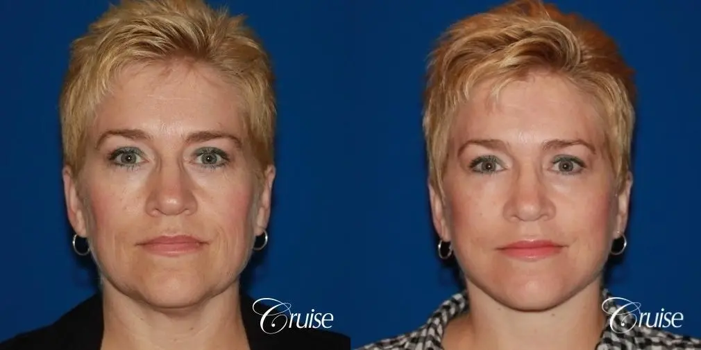 Facelift in Newport Beach, CA - Before and After 1