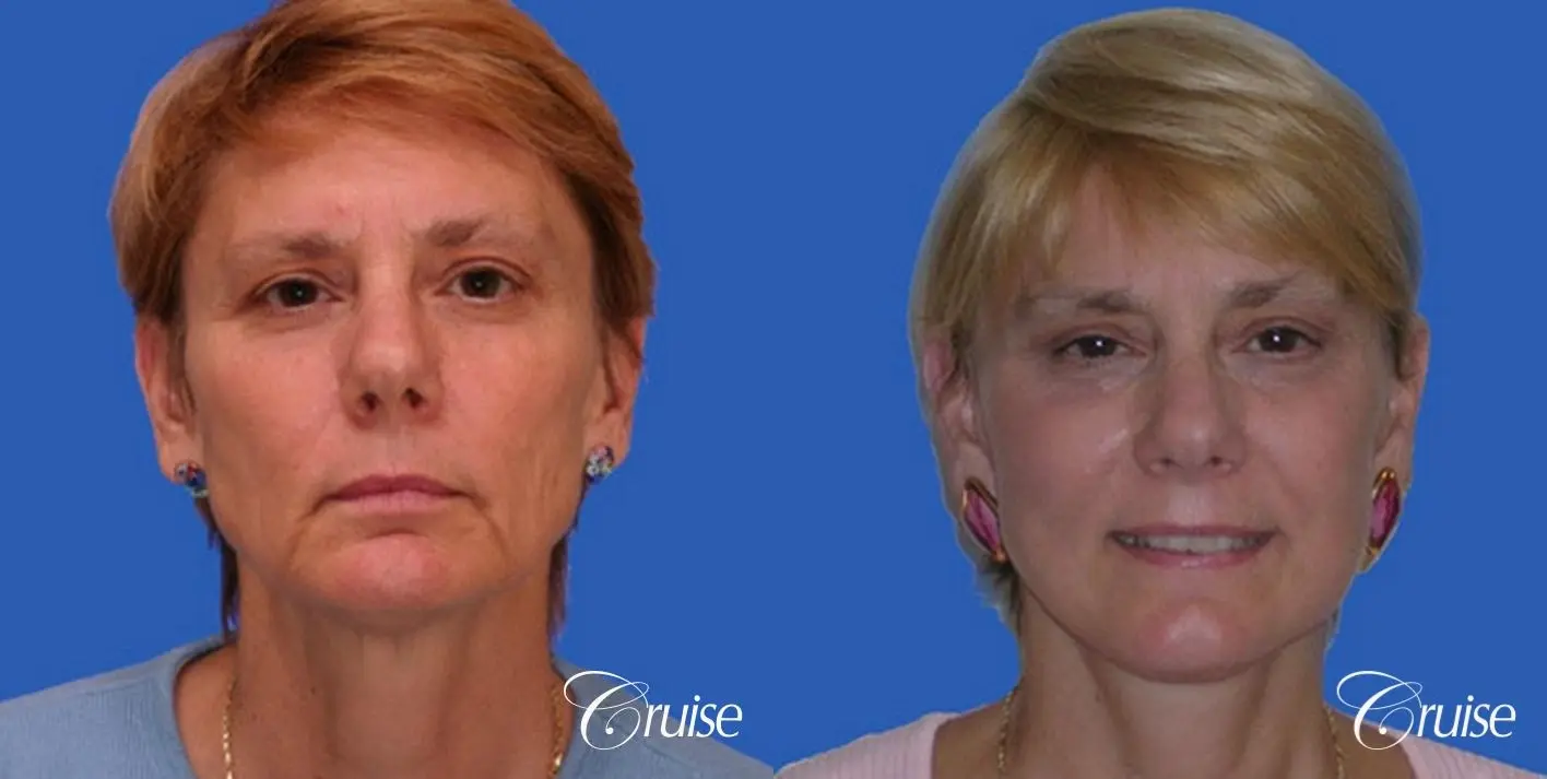 Facelift - Before and After 1