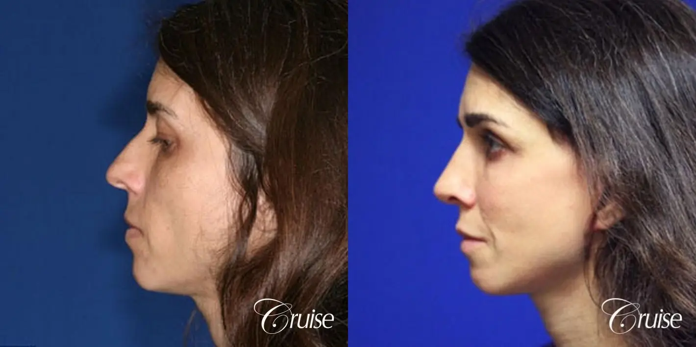 complete facial rejuvenation orange county - Before and After 2