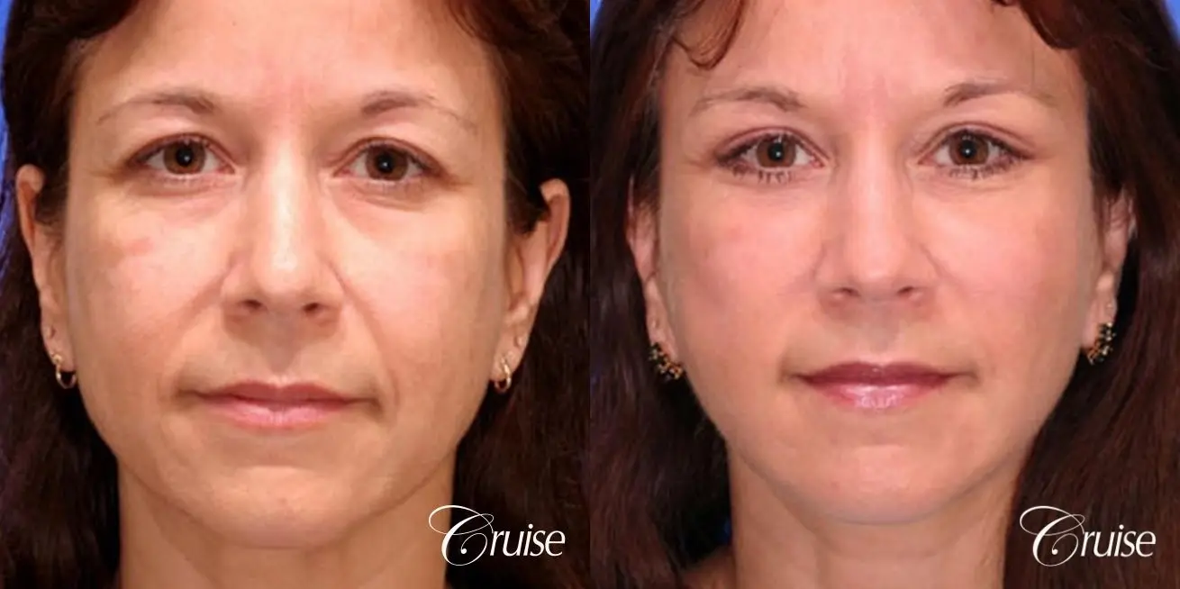 Facelift - Before and After 1