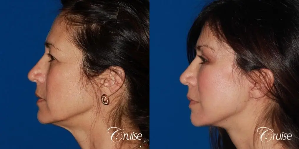 Facelift - Before and After 1